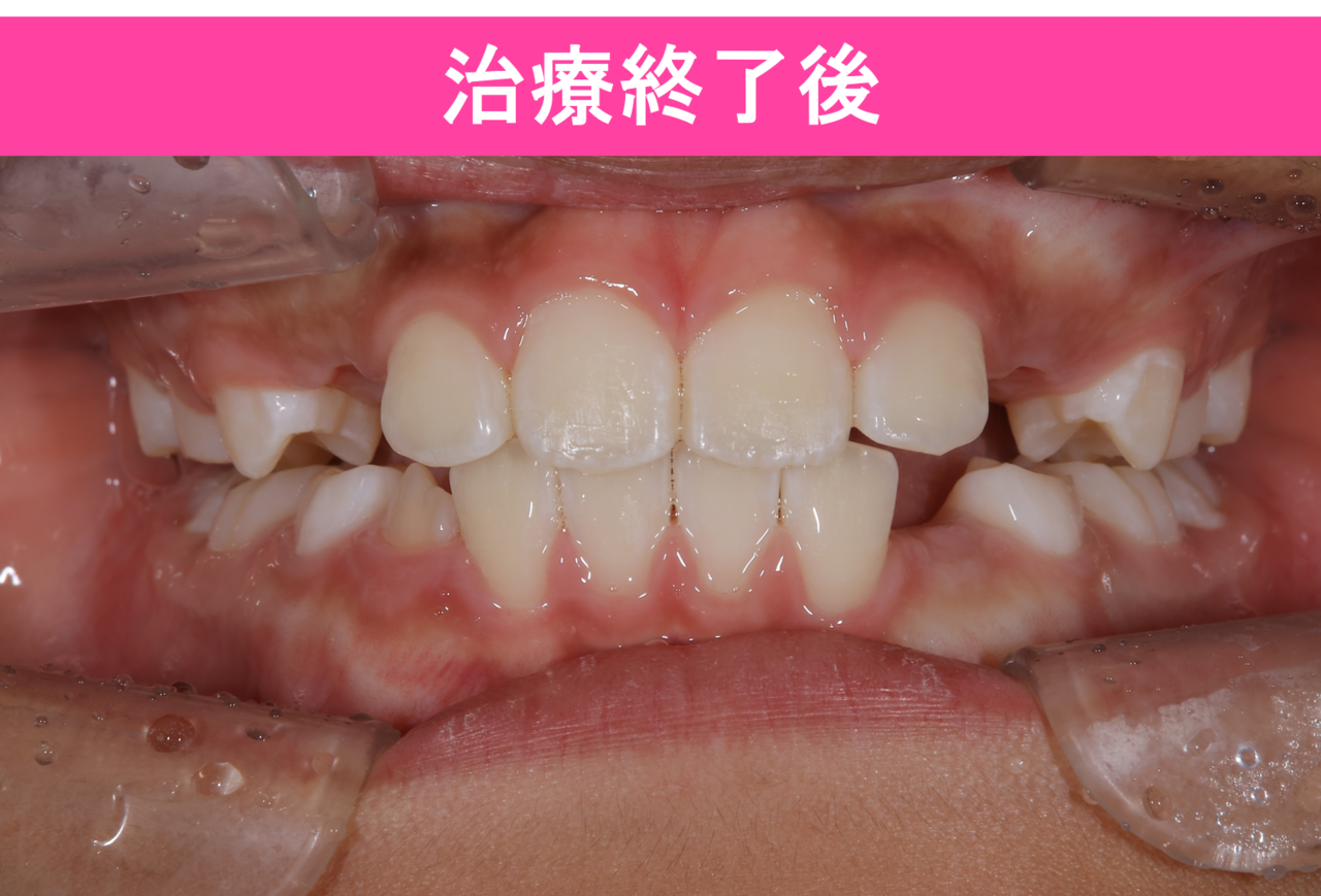 1期矯正治療の症例写真