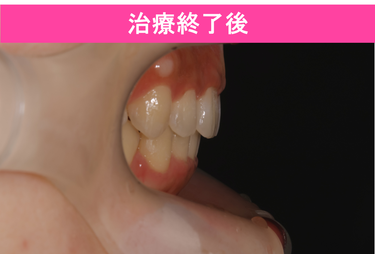 ガタガタ・叢生の歯並びの矯正治療後