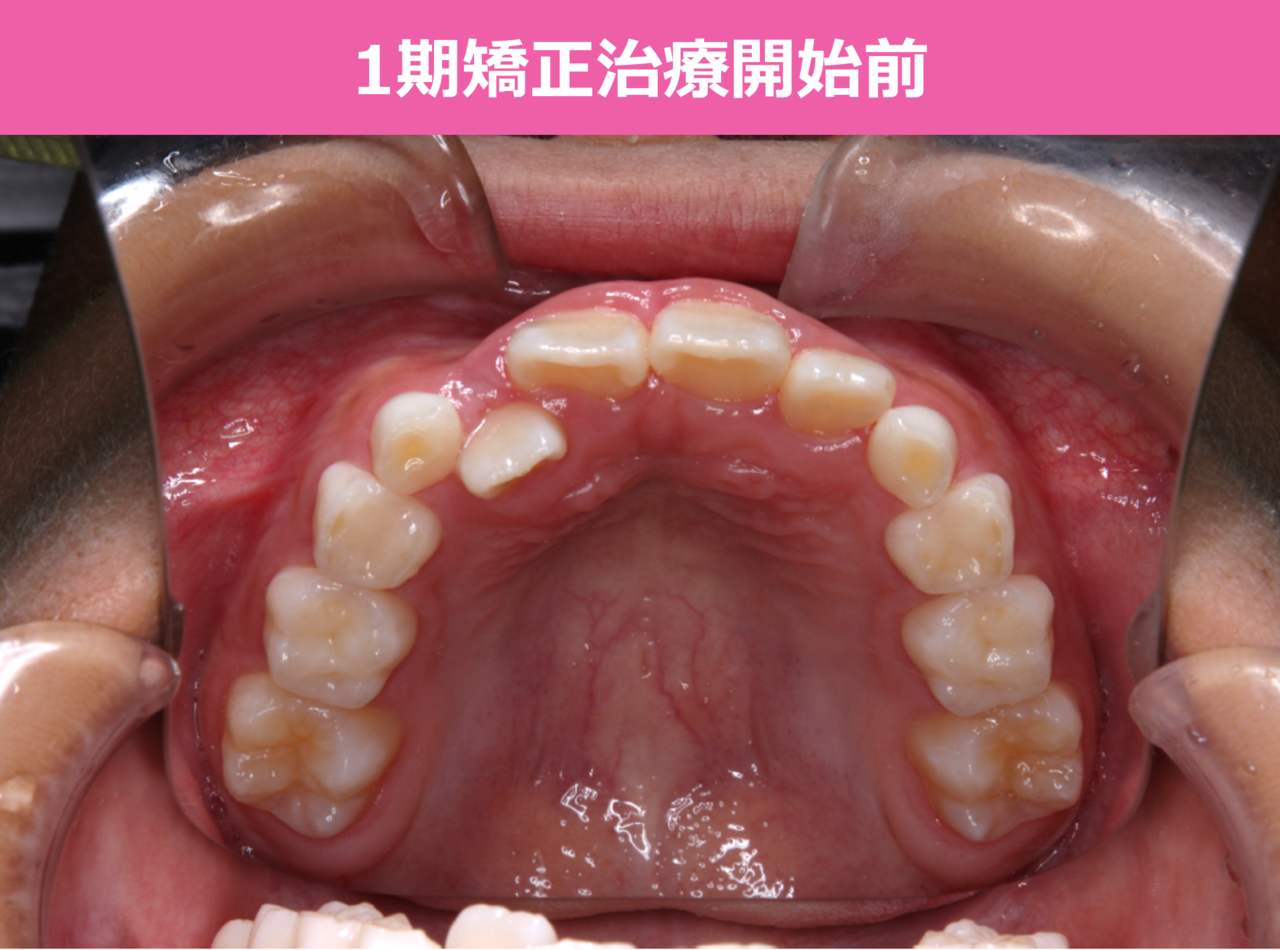 1期矯正治療の症例写真