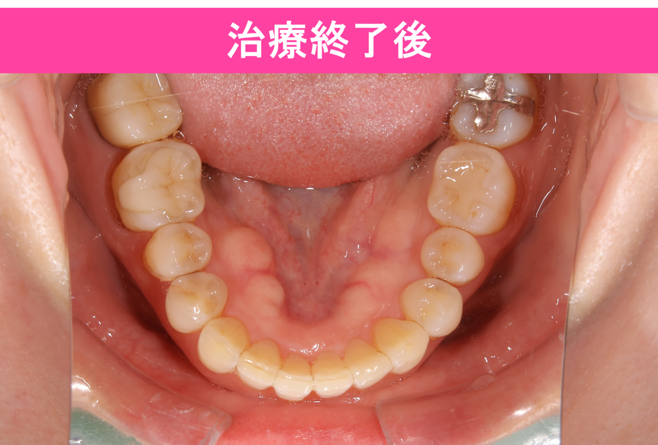 ガタガタ・叢生の歯並びの保定