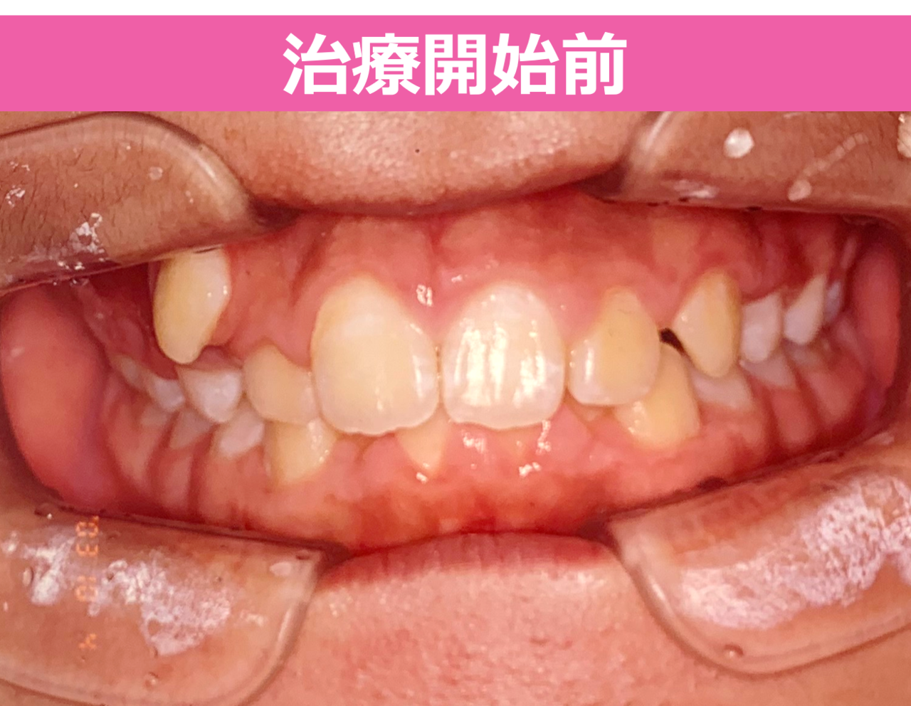 ガタガタ・叢生の歯並びの矯正治療前