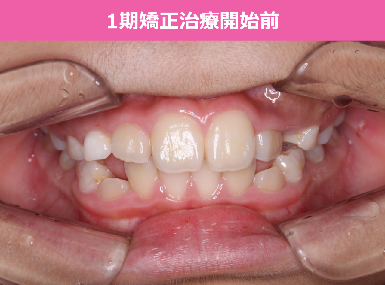 1期矯正治療の症例写真