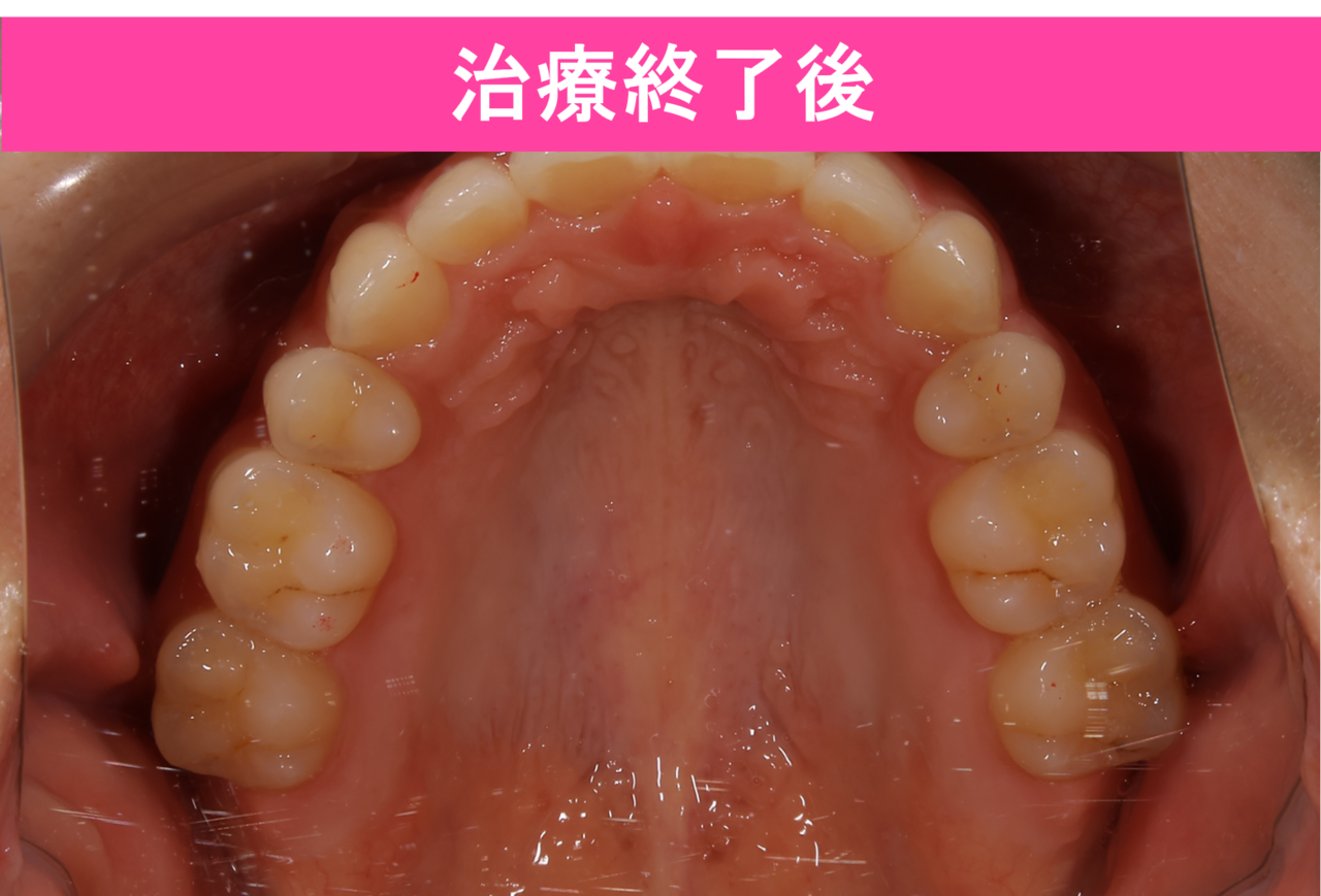 ガタガタ・叢生の歯並びの保定