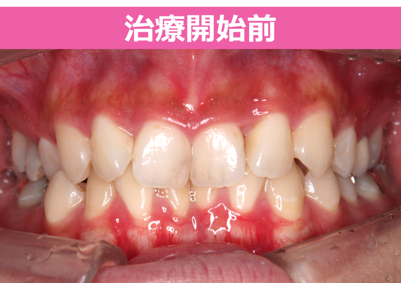 矯正治療の症例写真