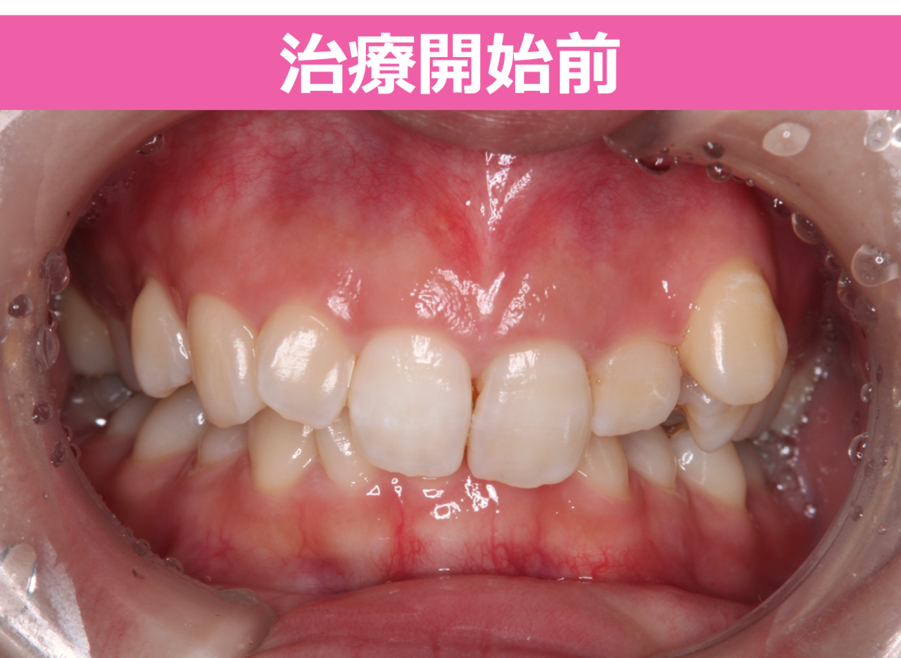 深い噛み合わせの過蓋咬合とガタガタの歯並びのワイヤー矯正治療前