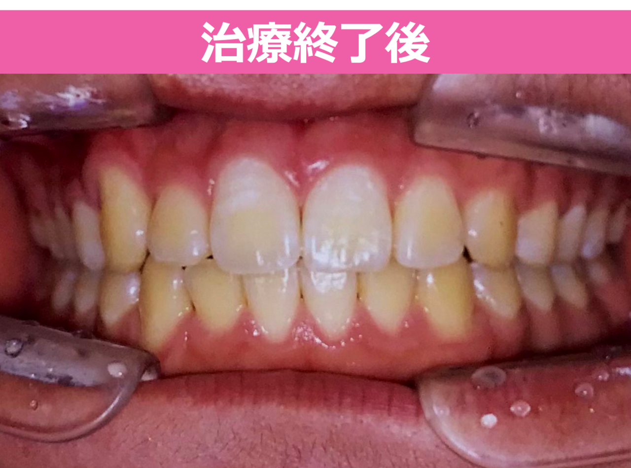 ガタガタ・叢生の歯並びの矯正終了後