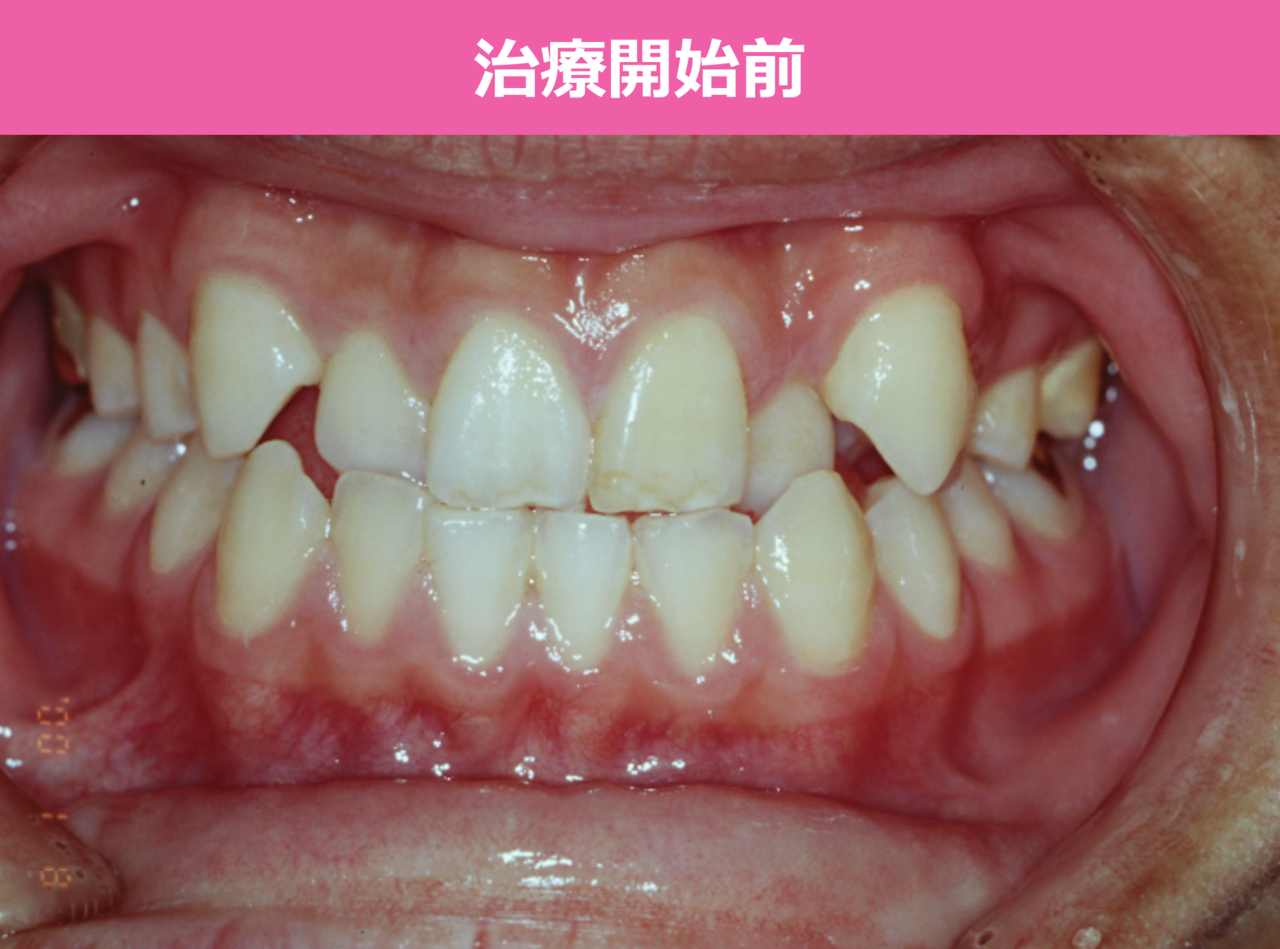 ガタガタの歯並びの矯正治療前