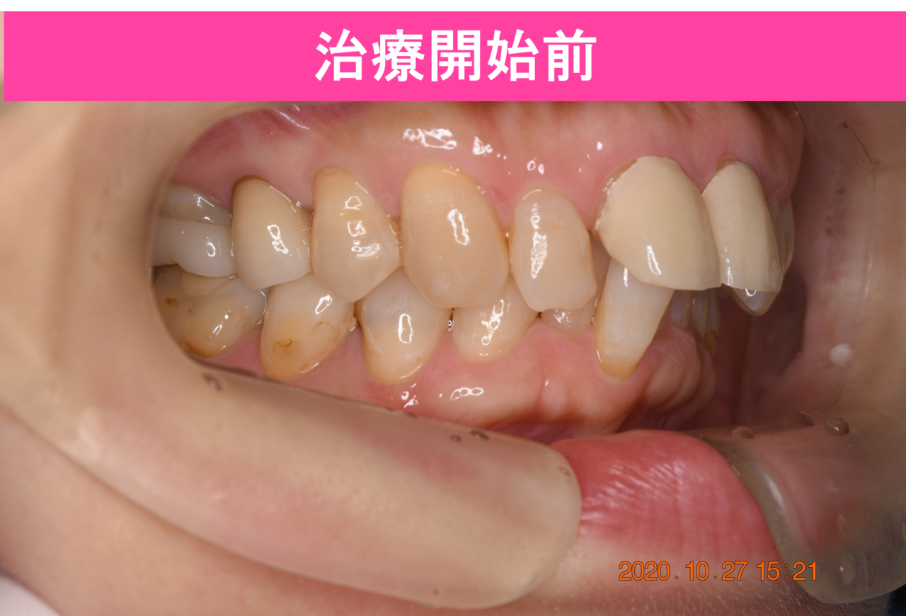 ガタガタ・叢生の歯並びの治療前
