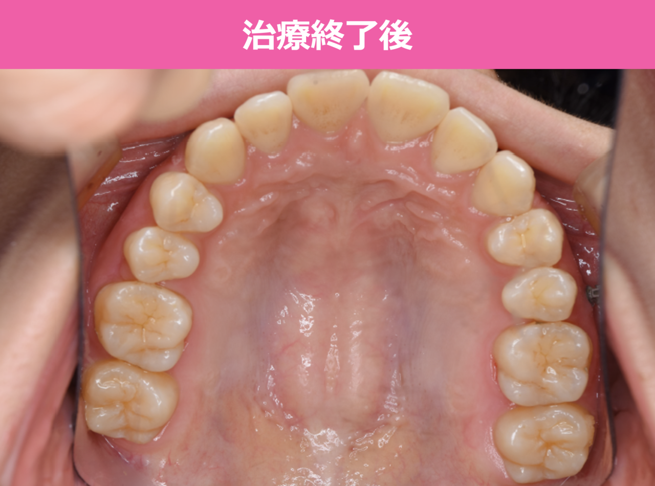 出っ歯の矯正治療後