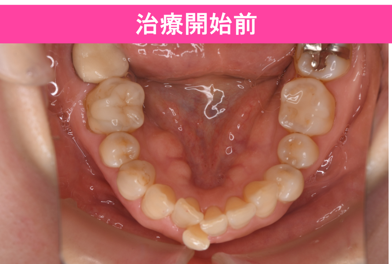 ガタガタ・叢生の歯並びの保定