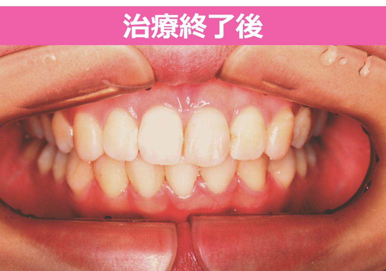 深い噛み合わせの過蓋咬合とガタガタの歯並びのワイヤー矯正治療後