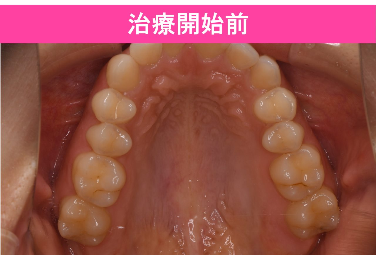 ガタガタ・叢生の歯並びの保定