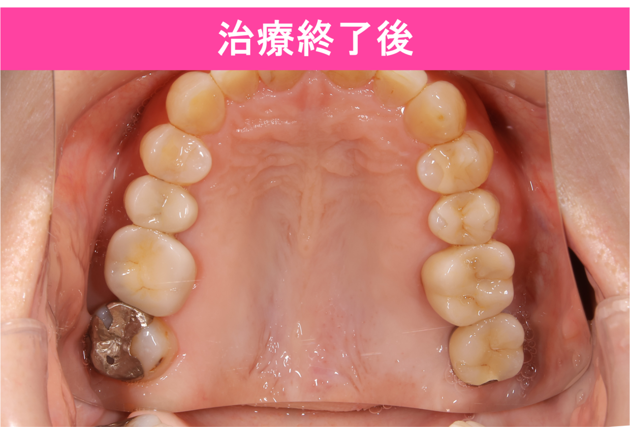 ガタガタ・叢生の歯並びの矯正治療後