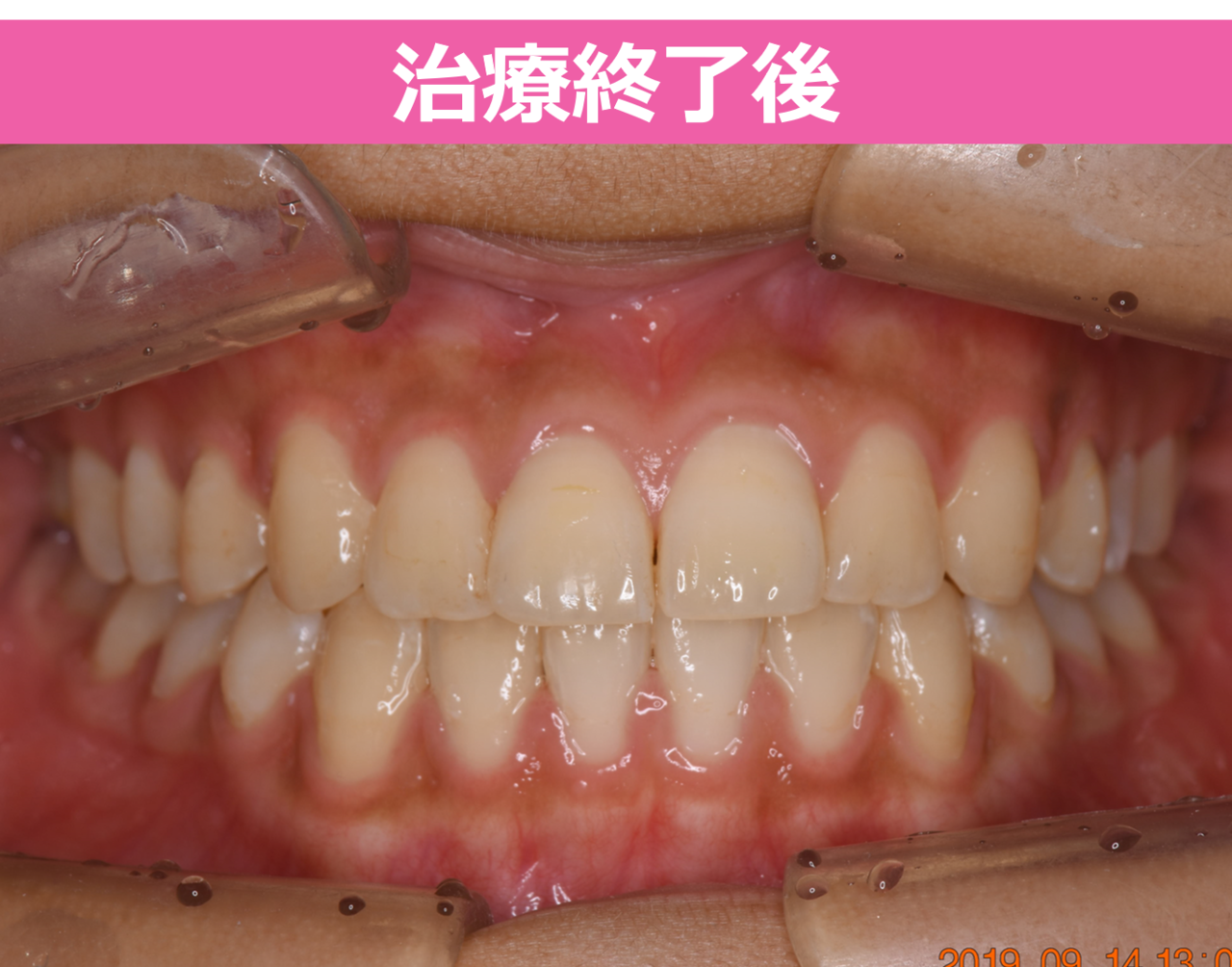 開口の矯正治療終了後