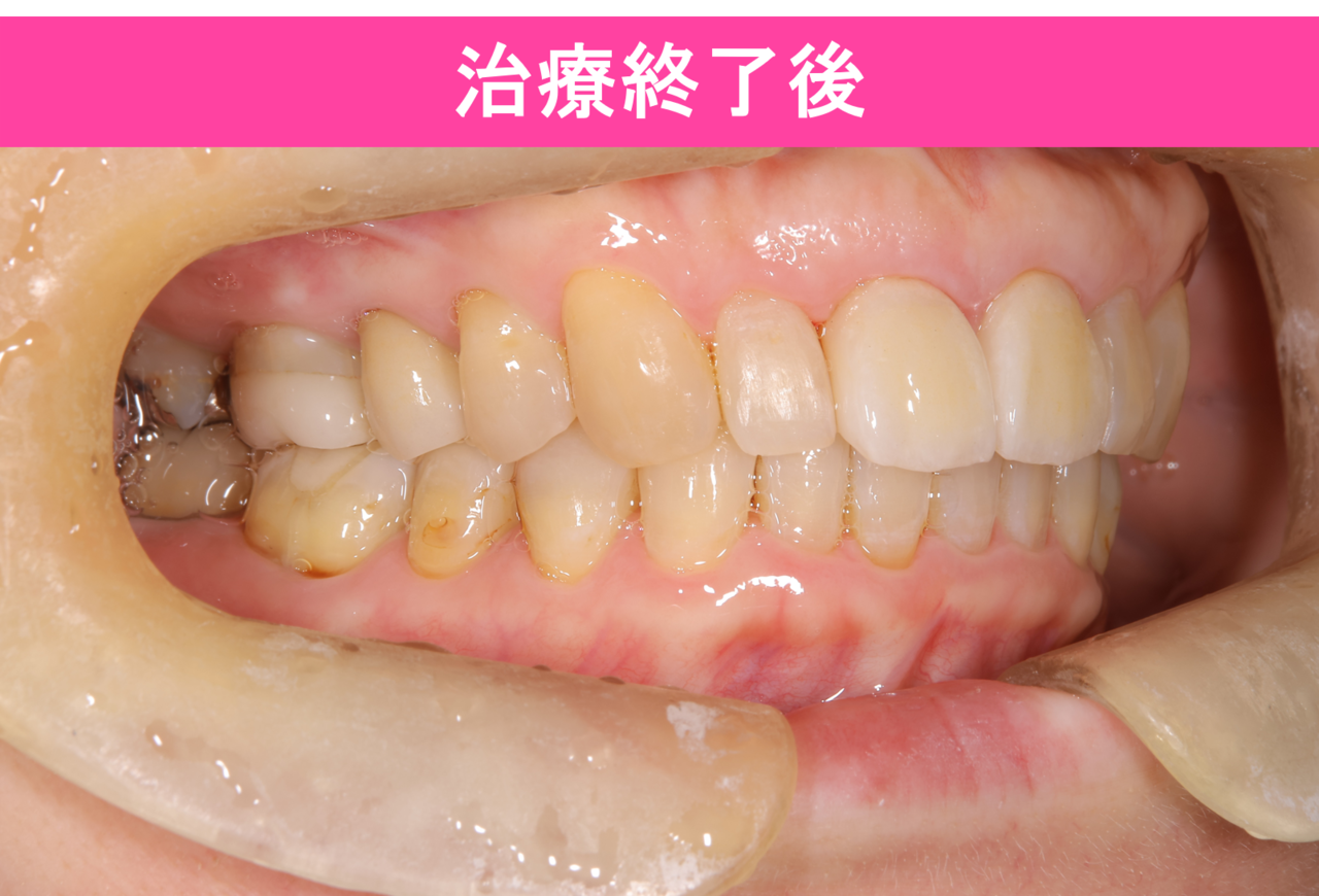 ガタガタ・叢生の歯並びの治療前
