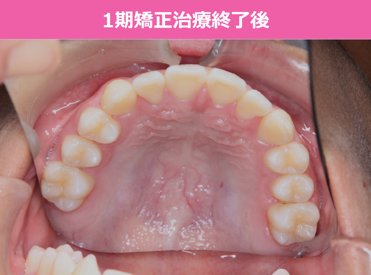 1期矯正治療終了後の症例写真