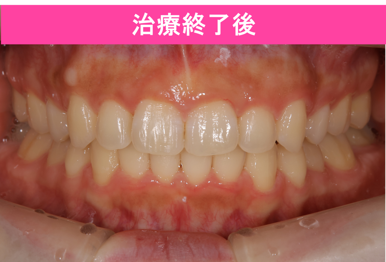 ガタガタ・叢生の歯並びの治療前