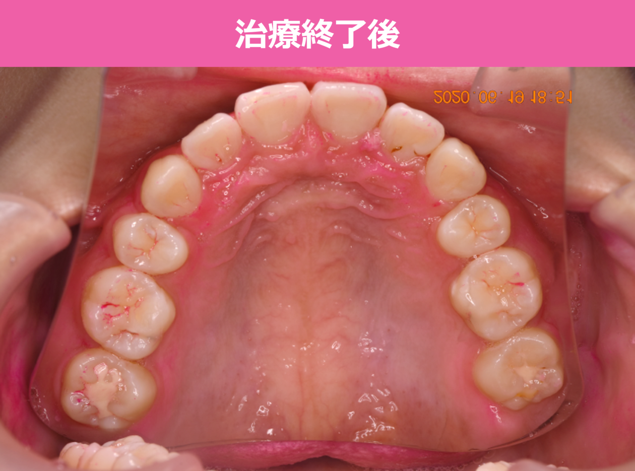 矯正治療終了後の症例写真