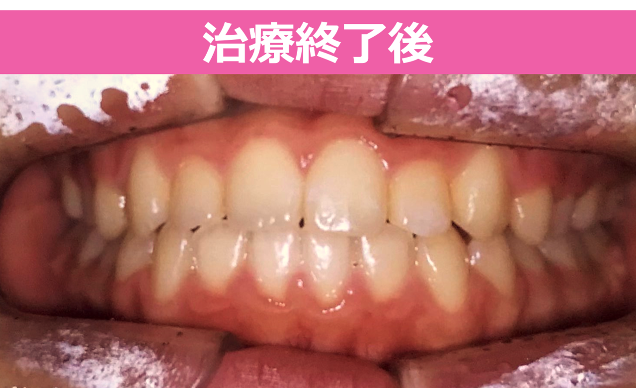 ガタガタ・叢生の歯並びの矯正治療後