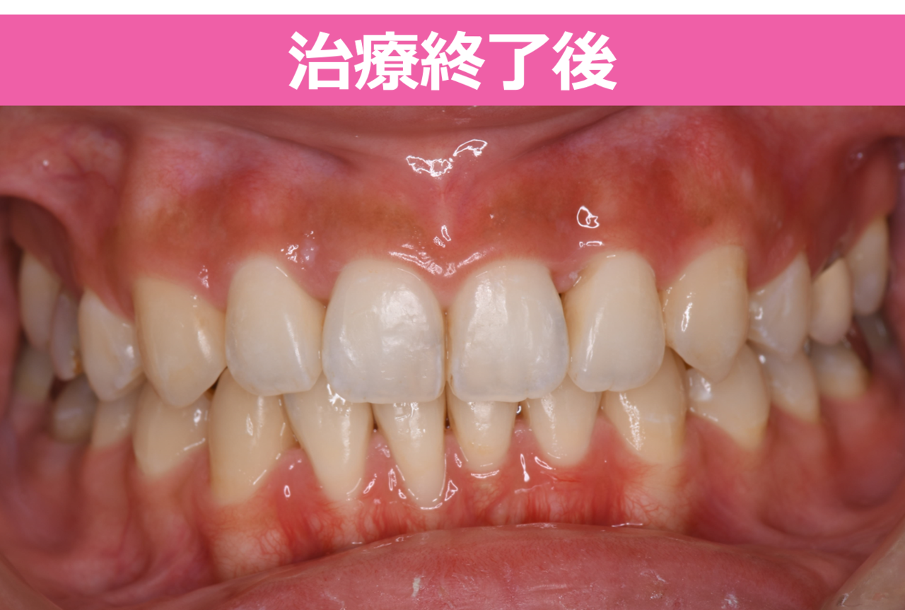 矯正治療終了後の症例写真