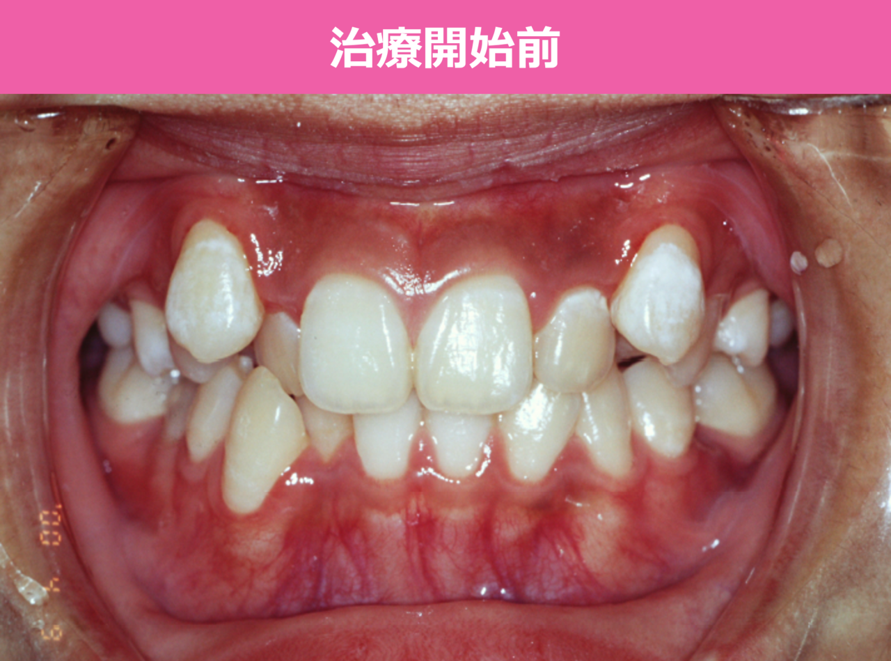 ガタガタの歯並びの矯正治療前
