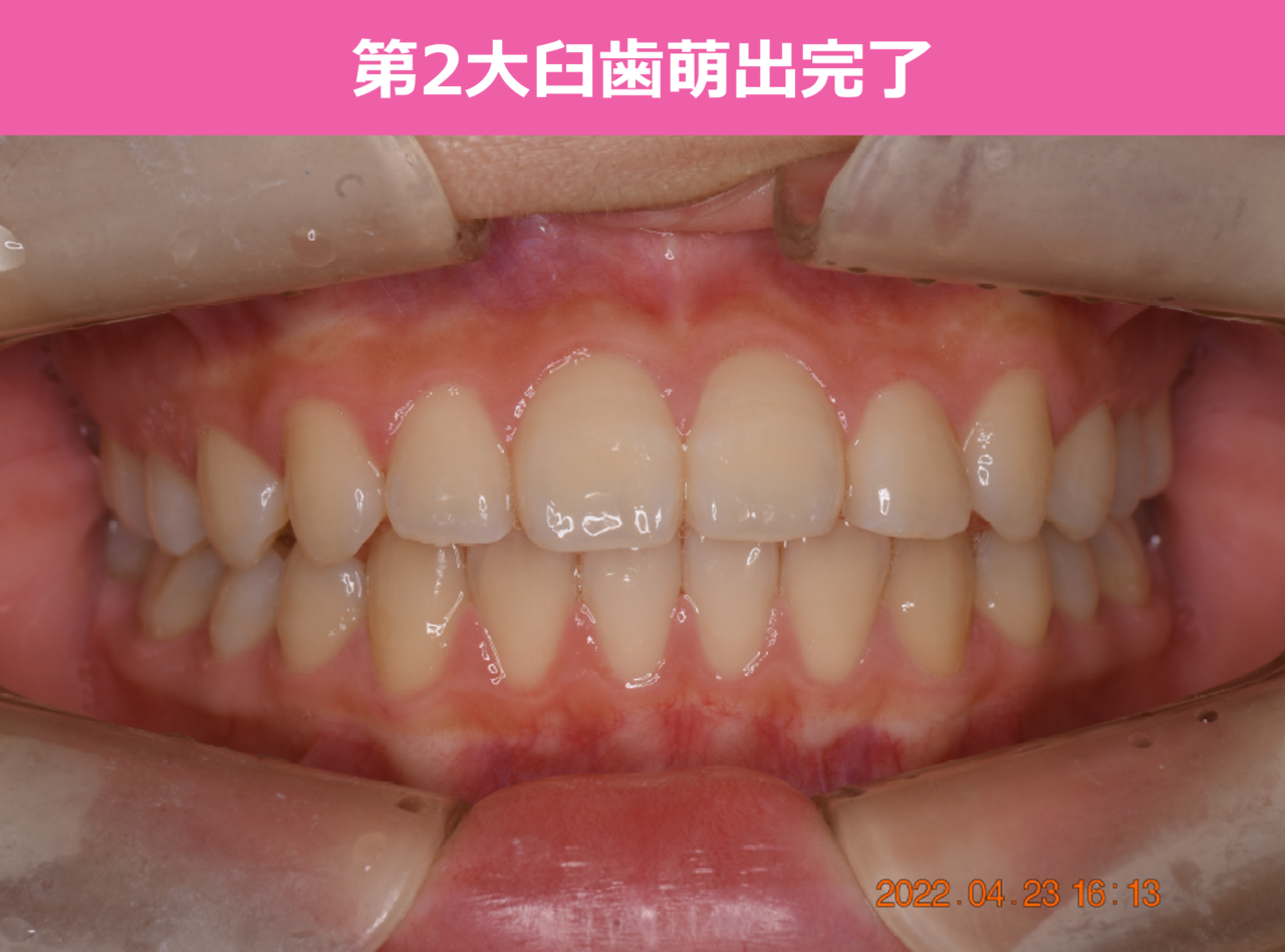 第2大臼歯萌出完了