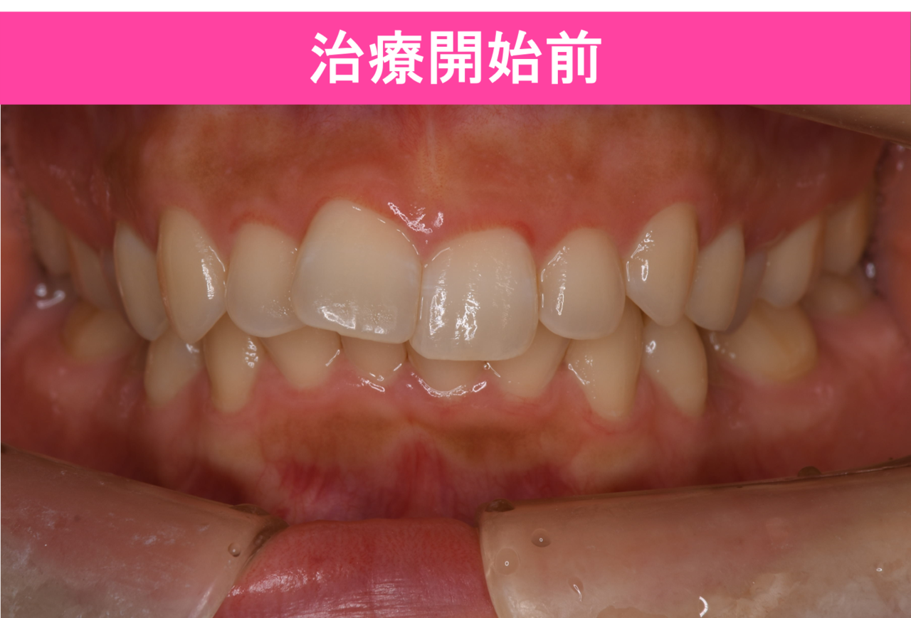 ガタガタ・叢生の歯並びの治療前