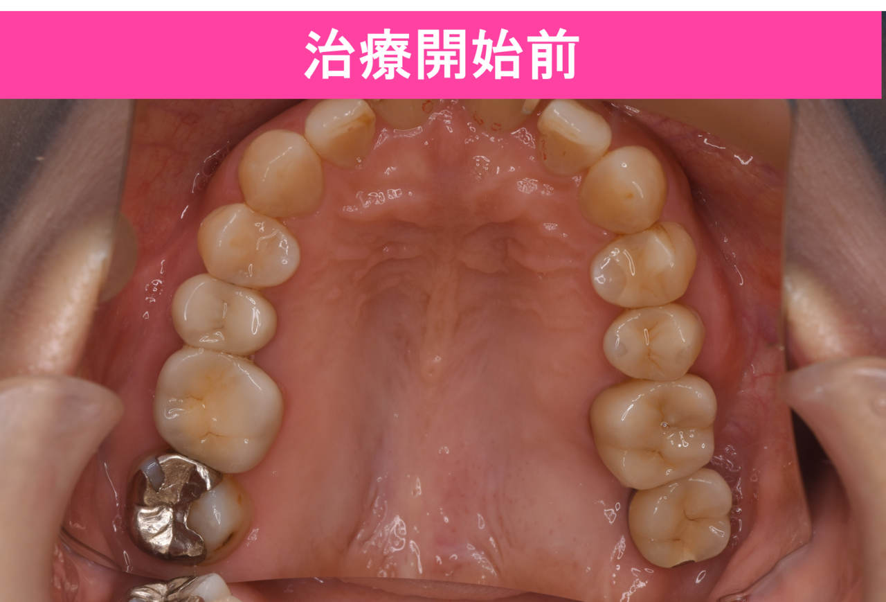 ガタガタ・叢生の歯並びの矯正治療後