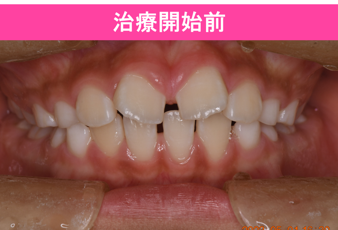 1期矯正治療の症例写真
