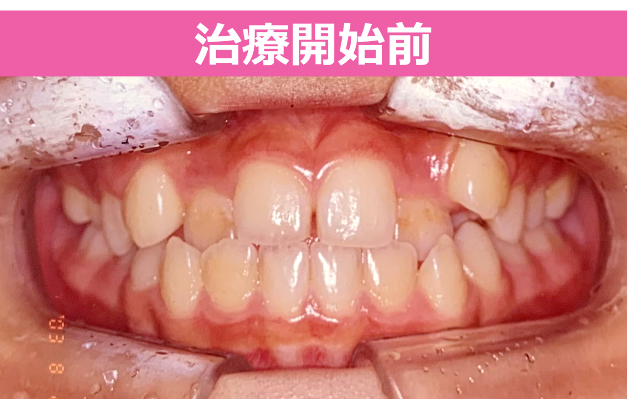 ガタガタ・叢生の歯並びの治療前