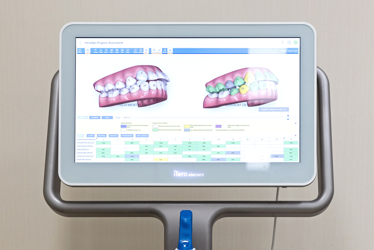 iTeroによる歯並びシミュレーション画像