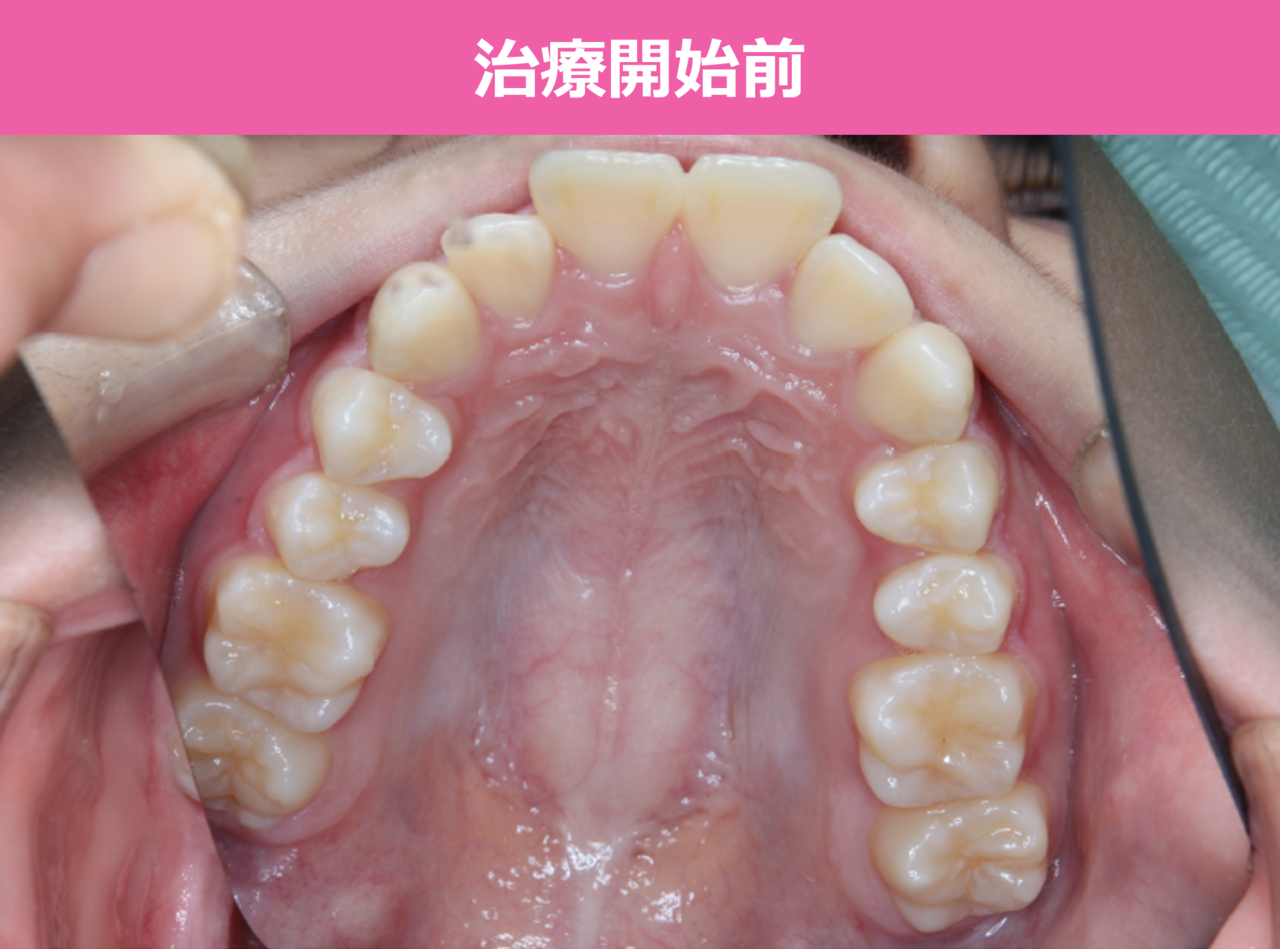 出っ歯の矯正治療前