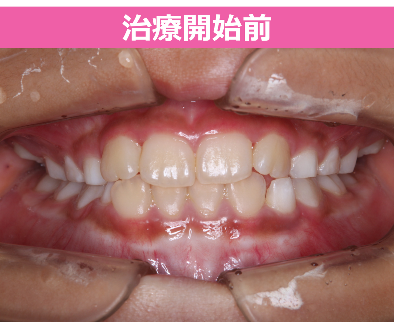 開口の矯正治療開始前