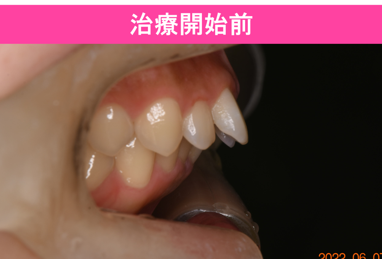 ガタガタ・叢生の歯並びの矯正治療後
