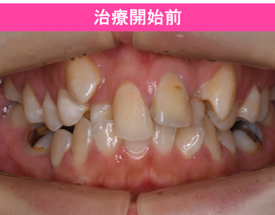 矯正治療の症例 - マウスピース型矯正装置・インビザライン専門